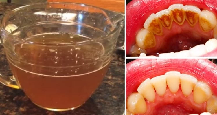 Το θαυματουργό ρόφημα που εξαφανίζει την πλάκα από τα δόντια σε χρόνο μηδέν!